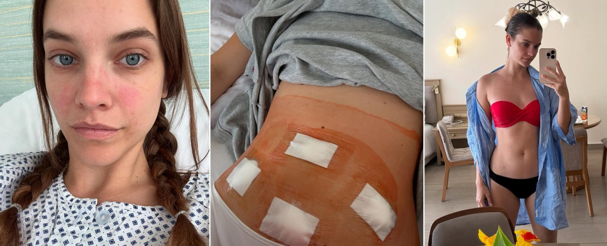 Palvin Barbi endometriózis