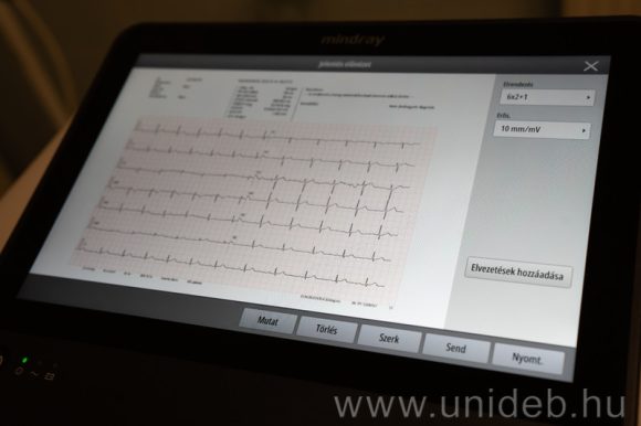 Digitális EKG Debrecenben