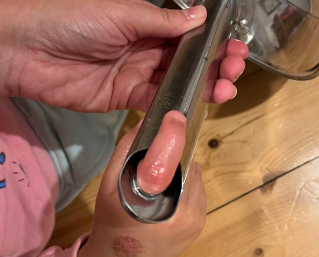 Hároméves kislány ujja beszorult egy serpenyőbe